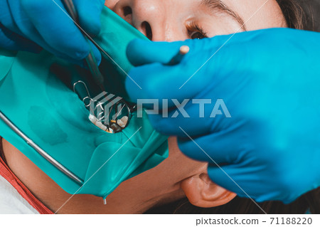 Restoration of a chewing surface by means of material for filling with photopolymer by means of the Rubber Dam system. Restoration of a chewing surface by means of material for filling with photopolymer by means of the Rubber Dam system. 71188220