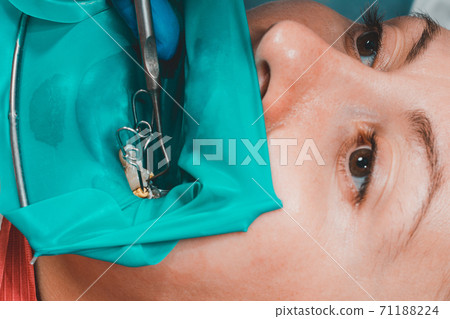 Dental restoration and polymerization of tooth composite materials, the doctor conducts sterile work on tooth restoration. Dental restoration and polymerization of tooth composite materials, the doctor conducts sterile work on tooth restoration. 71188224