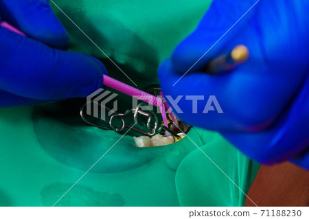 A patient at a dentist's appointment, a doctor uses a rubber dam to treat teeth, disinfects a tooth for filling. A patient at a dentist's appointment, a doctor uses a rubber dam to treat teeth, disinfects a tooth for filling. 71188230