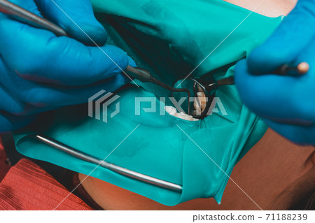 Treatment of posterior tooth, mouth covered with rubber dam, sterile treatment with modern technology. Treatment of posterior tooth, mouth covered with rubber dam, sterile treatment with modern technology. 71188239