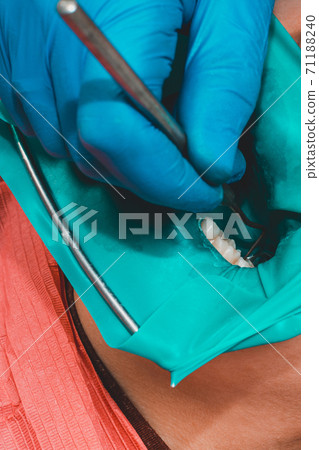 Treatment of posterior tooth, mouth covered with rubber dam, sterile treatment with modern technology. Treatment of posterior tooth, mouth covered with rubber dam, sterile treatment with modern technology. 71188240