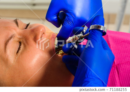 Local anesthesia, the dentist uses a carpal syringe, introducing local anesthesia into the gums. 71188255