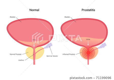 Prostatitis inflammation problem 71199096