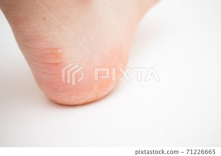Big callus on heel. Feet with callus of dead skin. Big callus on heel. Feet with callus of dead skin. 71226665