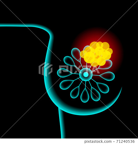 Breast disease concept Breast disease concept 71240536