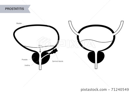 Prostatitis inflammation problem 71240549