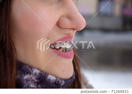 brasket system in smiling mouth, macro photo teeth, close-up lips, brasket system in smiling mouth, macro photo teeth, close-up lips, 71269831