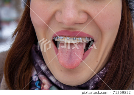 brasket system in smiling mouth, macro photo teeth, close-up lips,  71269832