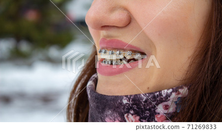 brasket system in smiling mouth, macro photo teeth, close-up lips, brasket system in smiling mouth, macro photo teeth, close-up lips, 71269833