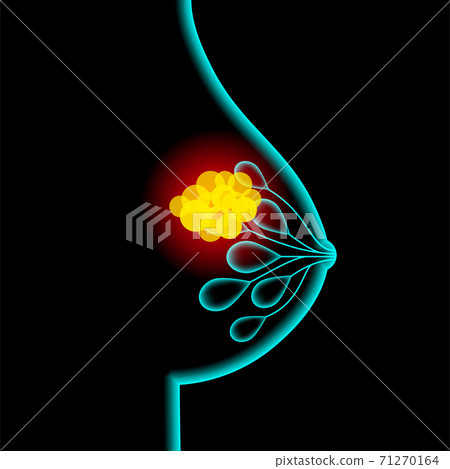 Breast disease concept 71270164