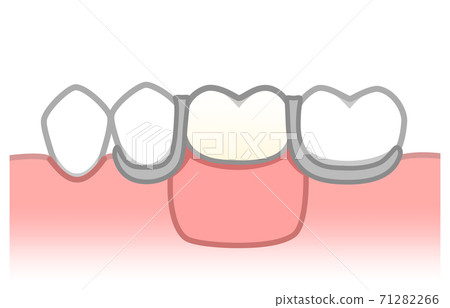 Partial denture illustration Partial denture illustration 71282266