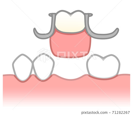 部分插入齒圖 71282267