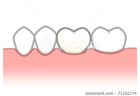 植入物圖 71282274