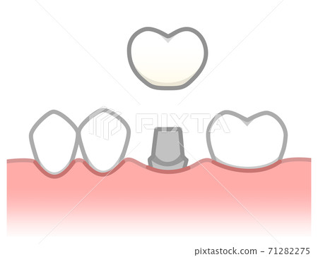 植入物圖 71282275