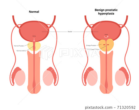 BPH info concept 71320592