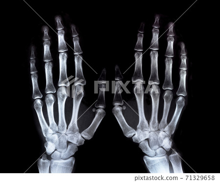 X-ray two hands fingers real scan 71329658