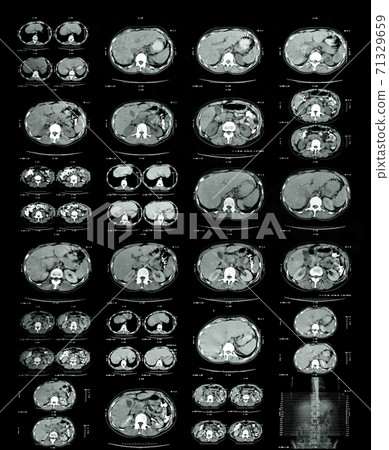 Magnetic Resonance Image of chest and thoracic spinal fusion 71329659