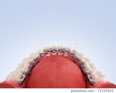 Lingual braces system on a demonstration denture 3d on color gradient 71335924