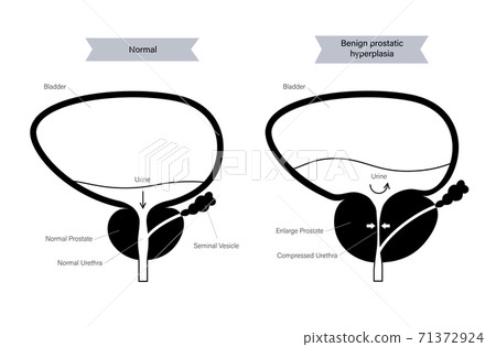 BPH info concept 71372924