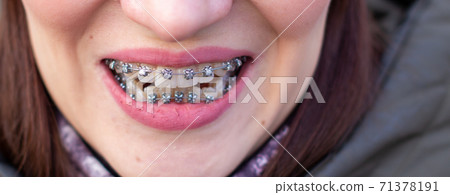 Braces on the girl's teeth, macro photo teeth, close-up lips,  71378191