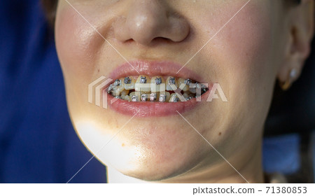A woman at a dentist's appointment to replace arches with braces. 71380853