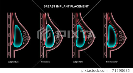 Breast Implant Concept 71390685