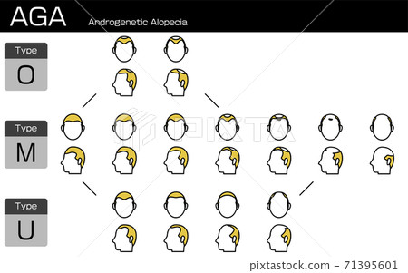 每種類型的aga男性脫髮和進展階段的插圖 插圖素材 圖庫