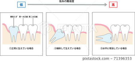 拔牙困難 71396353