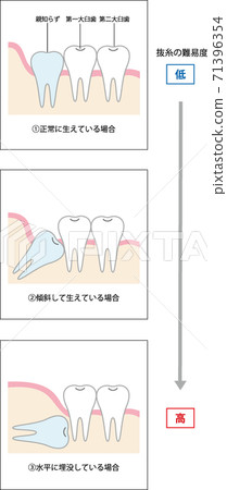 Difficulty of wisdom tooth extraction Difficulty of wisdom tooth extraction 71396354