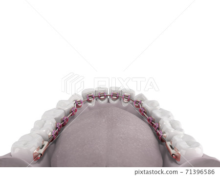 Lingual braces system on a demonstration denture 3d on color gradient 71396586