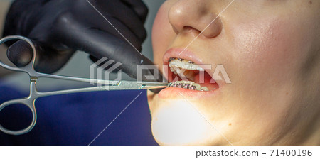 A woman at a dentist's appointment to replace arches with braces. A woman at a dentist's appointment to replace arches with braces. 71400196