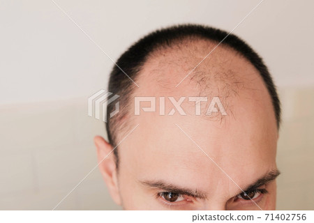 Young man looking at mirror worry about balding. Young man looking at mirror worry about balding. 71402756