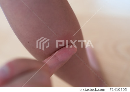 將藥物塗在兒童小腿上的昆蟲叮咬上 71410505