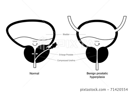 BPH info concept - Stock Illustration [71420554] - PIXTA