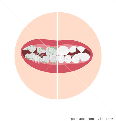 White healthy teeth and teeth with green plaque, bacteria, virus. 71424826