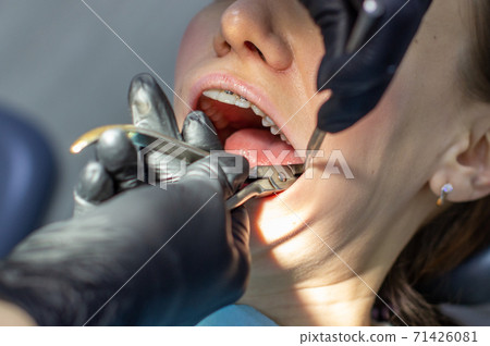 A woman at a dentist's appointment to replace arches with braces. 71426081