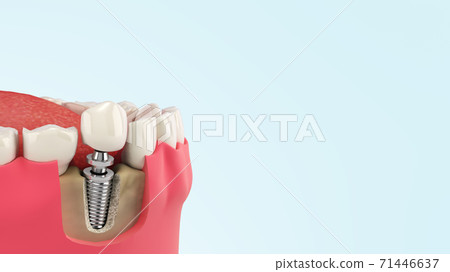 Tooth human single implant Dental concept Human teeth or dentures  3d render on blue gradient 71446637