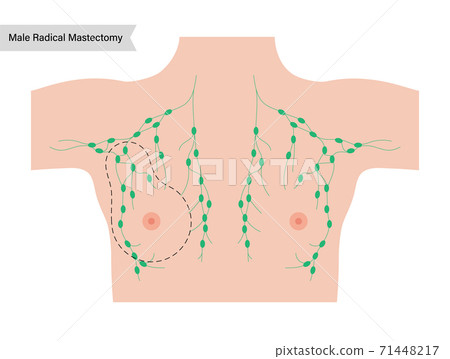 Breast disease concept 71448217