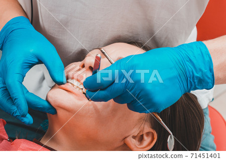 After filling, the dentist removes the excess material from the tooth with a copying tracing paper. 71451401