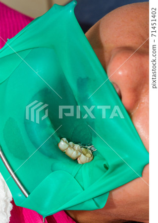 treatment of a chewing tooth, the dentist put a rubber dam, uses sterile tools, uses modern technology. 71451402