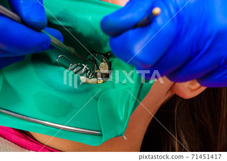 Restoration of a chewing surface by means of material for filling with photopolymer by means of the Rubber Dam system. 71451417