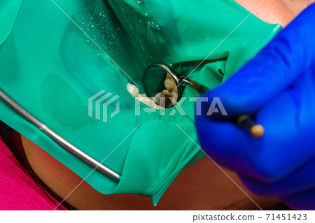 Treatment of posterior tooth, mouth covered with rubber dam, sterile treatment with modern technology. Treatment of posterior tooth, mouth covered with rubber dam, sterile treatment with modern technology. 71451423