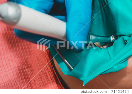 Treatment of posterior tooth, mouth covered with rubber dam, sterile treatment with modern technology. Treatment of posterior tooth, mouth covered with rubber dam, sterile treatment with modern technology. 71451424