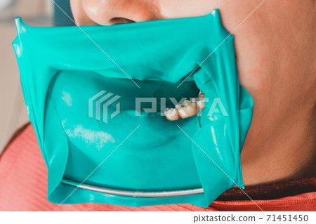 The dentist installs a rubber dam, sterile dental treatment, modern equipment in dentistry. 71451450