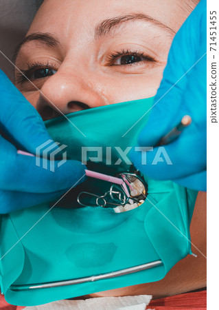 A patient at a dentist's appointment, a doctor uses a rubber dam to treat teeth, disinfects a tooth for filling. A patient at a dentist's appointment, a doctor uses a rubber dam to treat teeth, disinfects a tooth for filling. 71451455