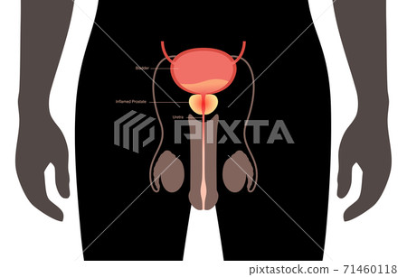 Prostatitis inflammation problem 71460118