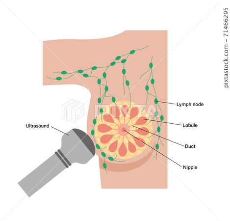 Breast disease concept 71466295