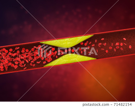 atherosclerosis with plaque in vessel atherosclerosis with plaque in vessel 71482154