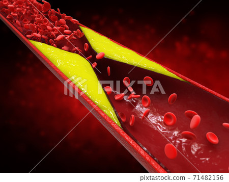 atherosclerosis with plaque in vessel atherosclerosis with plaque in vessel 71482156