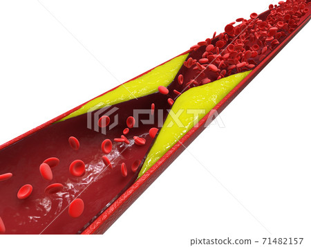 atherosclerosis with plaque in vessel 71482157